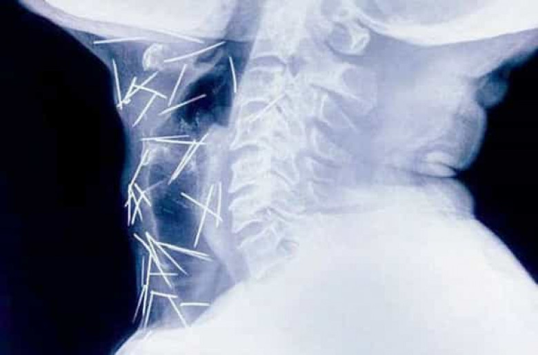 Հնդկաստանում բժիշկները 91 քորոց են դուրս բերել տղամարդու մարմնից